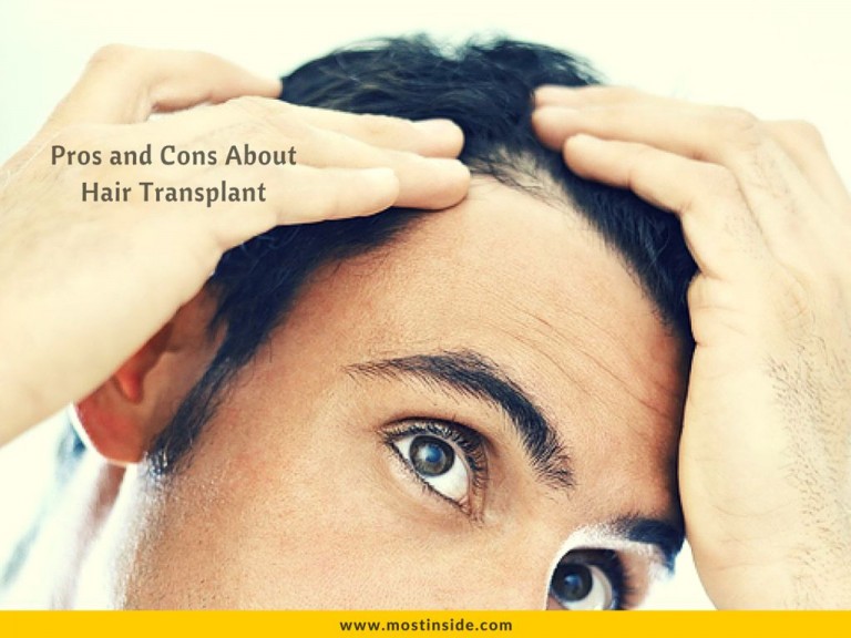 Pros and Cons About Hair Transplant
