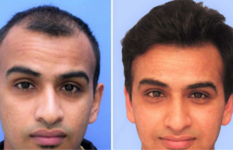 Opt for Cost Effective Hair Transplant in Delhi