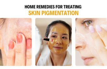 Natural Home Remedies For Treating Skin Pigmentation