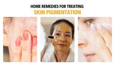 Natural Home Remedies For Treating Skin Pigmentation