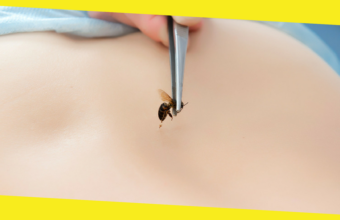 Prevention And Home Remedies For Bee Stings