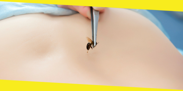 Prevention And Home Remedies For Bee Stings