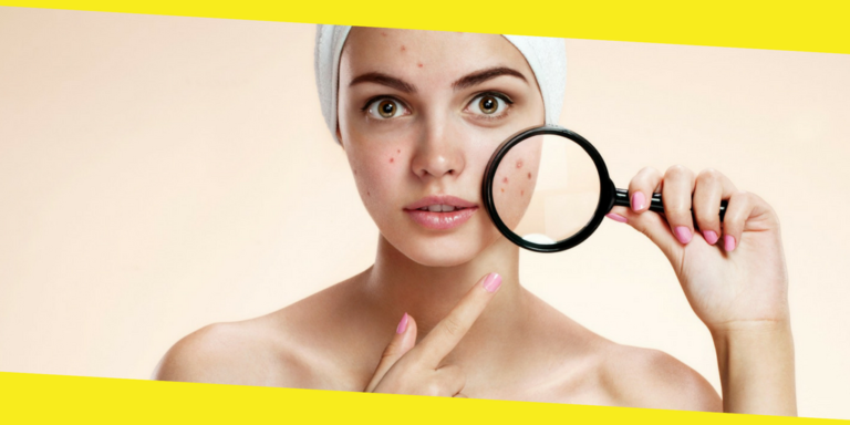 Amazing Tips for Pimple Cure – Quick Read