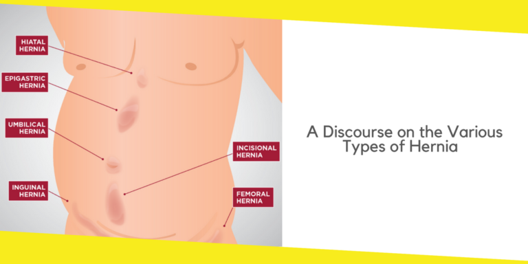 A Discourse on the Various Types of Hernia