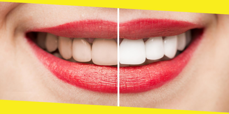 Dummies Guide to Teeth Whitening Products in Australia