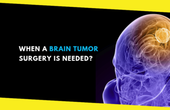 How to Know When a Brain Tumor Surgery is Needed?