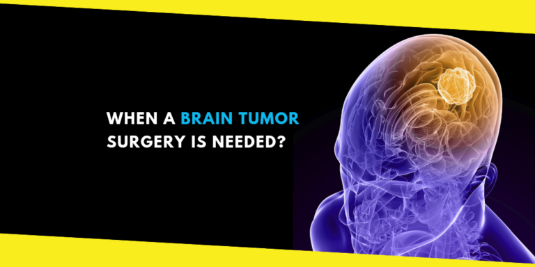 How to Know When a Brain Tumor Surgery is Needed?