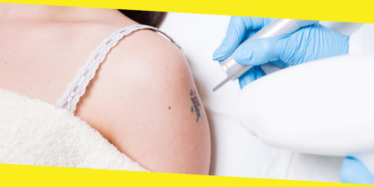What to Consider Before You Remove Your Tattoo