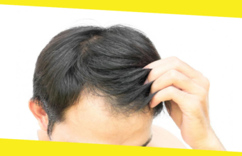 How to Reverse Hair Loss From Burns?