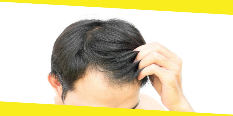 How to Reverse Hair Loss From Burns?