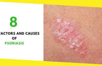 8 Risk Factors and Causes of Psoriasis