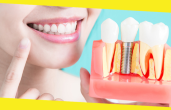 How Much Do Dental Implants Cost?