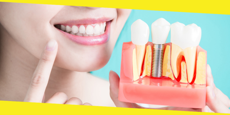 How Much Do Dental Implants Cost?
