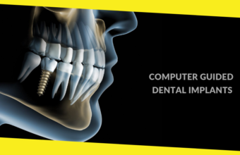 4 Things You Should Know About Computer Guided Dental Implants