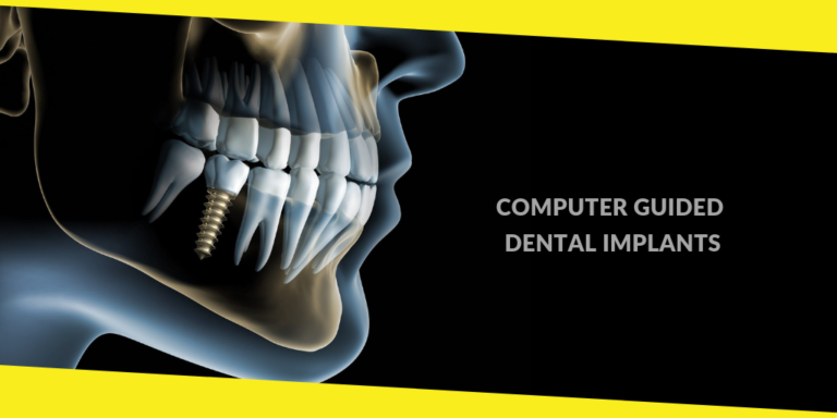 4 Things You Should Know About Computer Guided Dental Implants