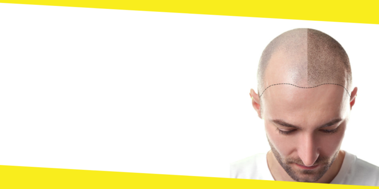 Considering An FUE Hair Transplant In The UK? Here’s What You Need To Know
