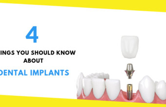 4 Things You Should Know About Dental Implants