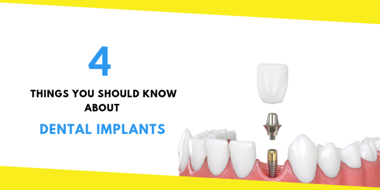 4 Things You Should Know About Dental Implants