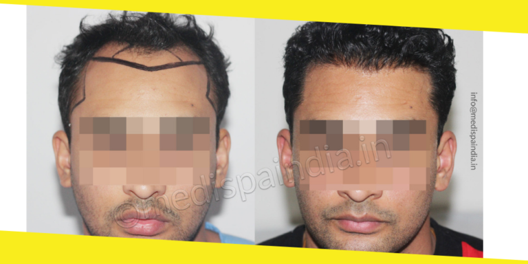 After Hair Transplant Care In Hair Restoration Surgery