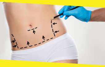 5 Myths And Facts About Tummy Tuck Surgery 