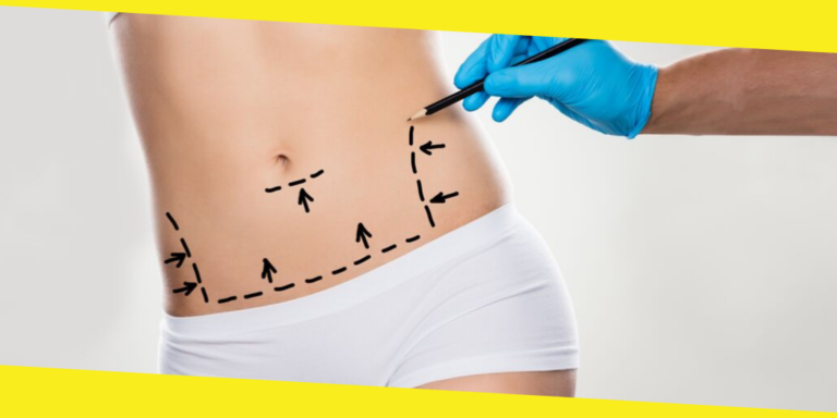 5 Myths And Facts About Tummy Tuck Surgery 