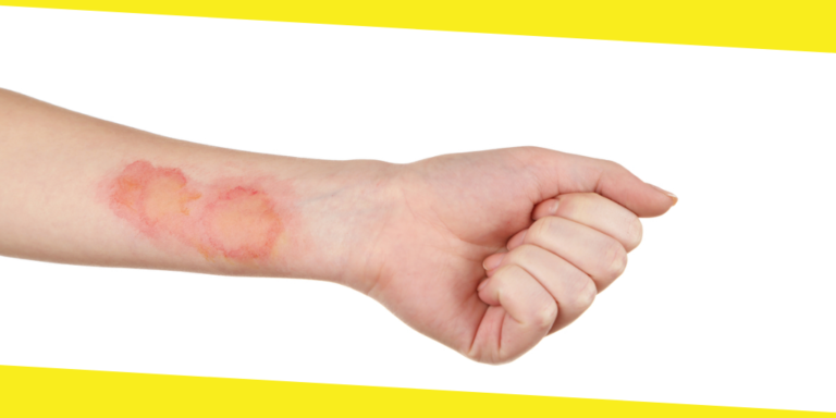 The Difference Between Burns and Scalds
