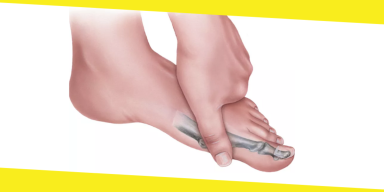 How Do I Know if I Need Arthrodesis Toe