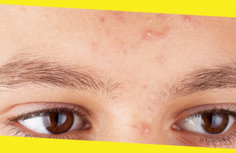 How to Get Rid of Acne for Good