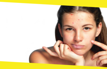 7 Must-Know Facts About Acne