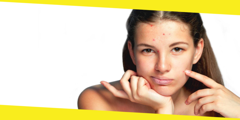 7 Must-Know Facts About Acne