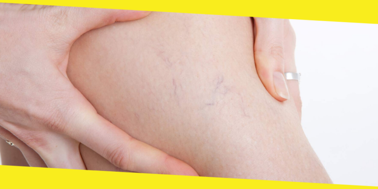Will My Spider Veins Ever Go Away?