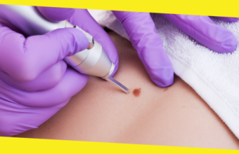 Your Cheat Sheet to Mole Removal in Singapore