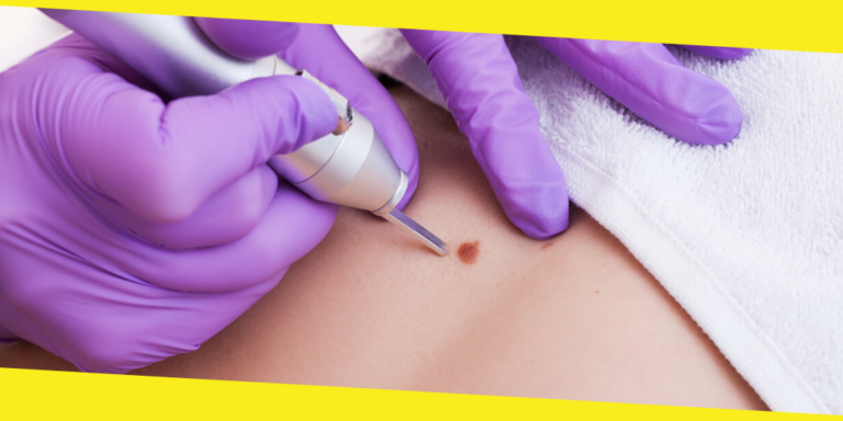 Your Cheat Sheet to Mole Removal in Singapore