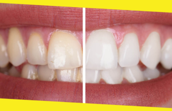 Pros and Cons of 6 Common Teeth Whitening Methods