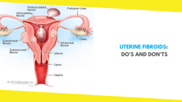 Uterine Fibroids: Do’s and Don’ts