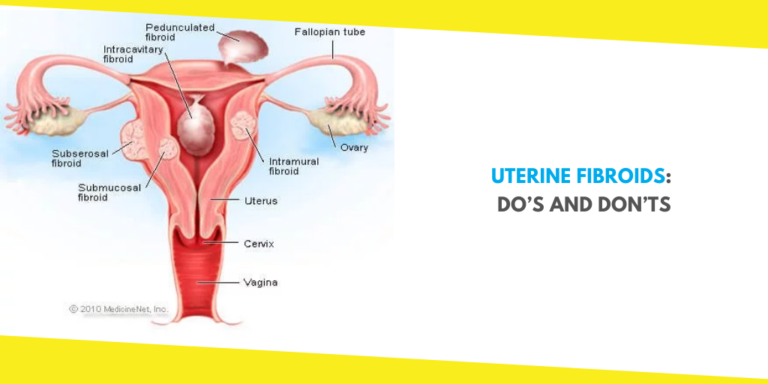 Uterine Fibroids: Do’s and Don’ts