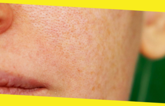 How to Find the Right Doctor to Remove Pigmentation from Face Permanently