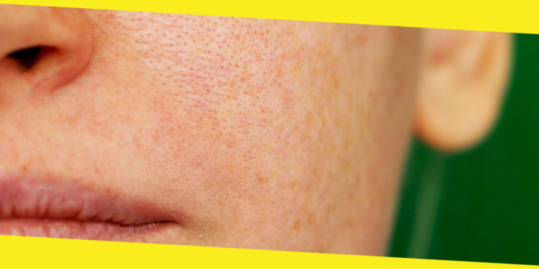 How to Find the Right Doctor to Remove Pigmentation from Face Permanently