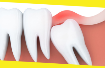 What Should You Do About a Wisdom Tooth Cavity? 