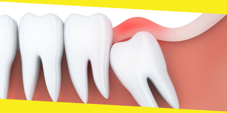 What Should You Do About a Wisdom Tooth Cavity? 