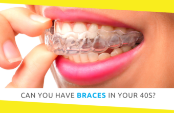 Can You Have Braces in Your 40s?