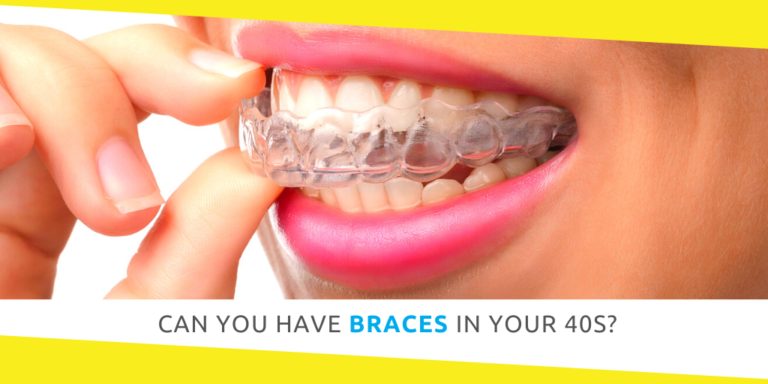 Can You Have Braces in Your 40s?