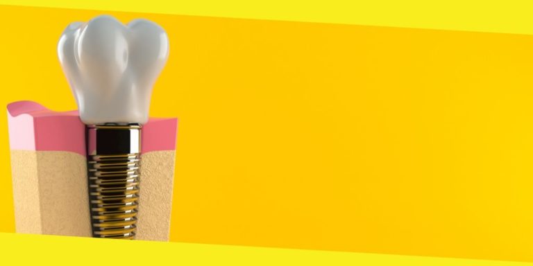 Are Dental Implants Worth the Cost?