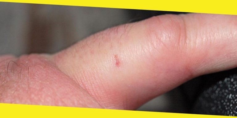 5 Home Remedies for Bee Stings