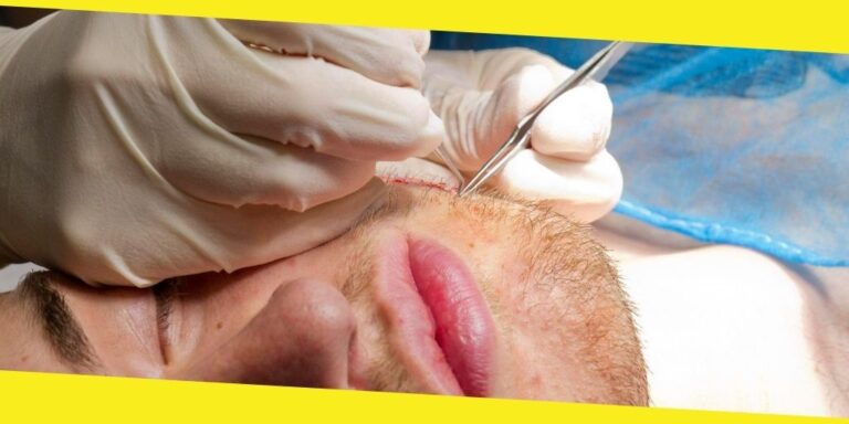 The Beard Transplant Process You May Not Know About