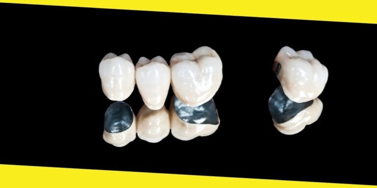 Lost a Dental Crown? Here’s What to Do