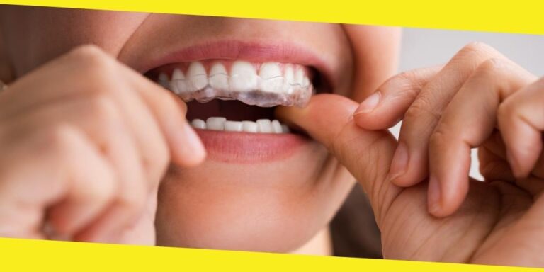 All About the Cost of Clear Aligners and More