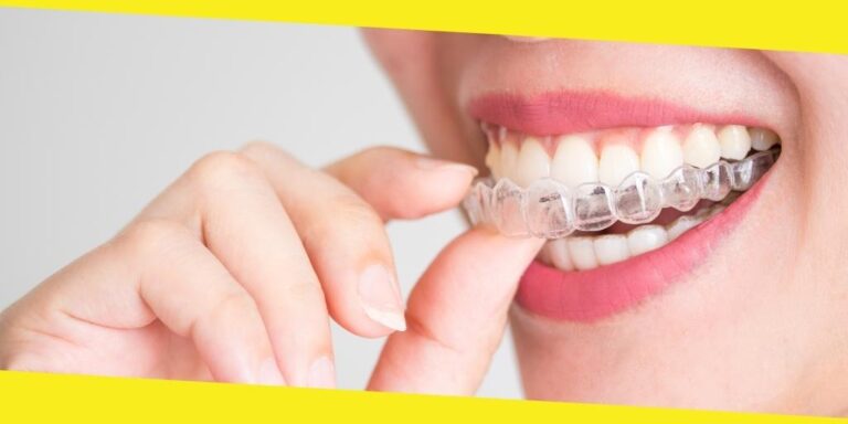 5 Factors To Look Into When Getting Invisalign In Winnipeg