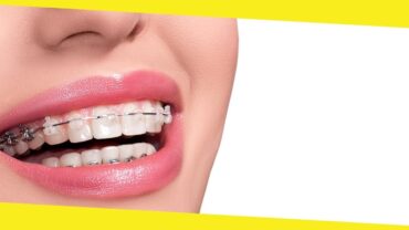 4 Options To Fix Crooked Teeth