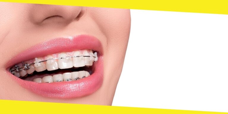 4 Options To Fix Crooked Teeth